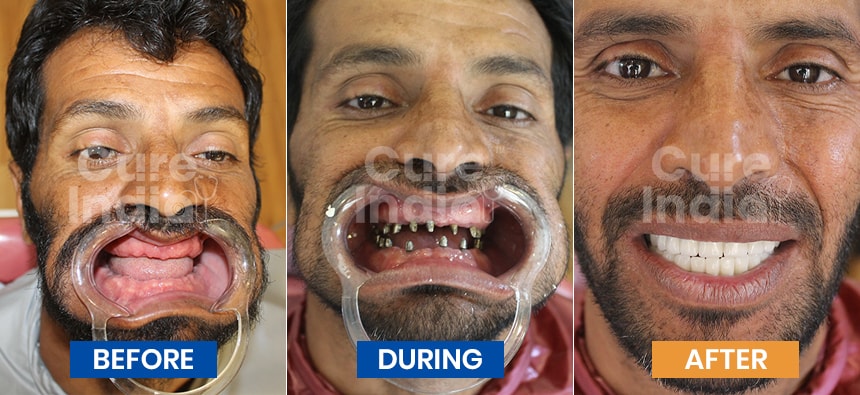 Dental implants before and after Case 7